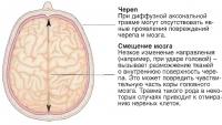 Диффузная аксональная травма