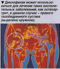 Диклофенак может использоваться для лечения таких воспалительных заболеваний, как остеоартрит