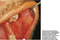 Для лишения чувствительности нижних зубов и десны производится инъекция в нижний альвеолярный нерв