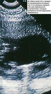 До аборта может быть проведено ультразвуковое исследование