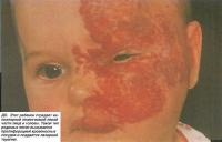 ДО. Этот ребенок страдает капиллярной гемангиомой левой части лица и головы