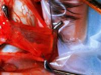 Две нити привязывают к латеральной прямой мышце, чтобы повторно присоединить её после укорачивания