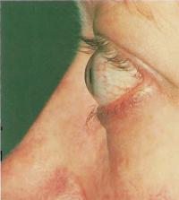 Экзофтальм при болезни Гоейвса. Возникает из-за отека тканей внутри глазной орбиты