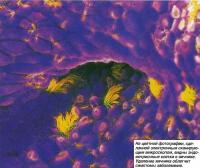 Эндометриозные клетки в яичнике