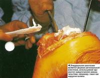 Эпидуральная анестезия является формой региональной анестезии