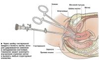 ерез шейку гистероскоп введен в полость матки, которая удерживается зажимом в неподвижном состоянии