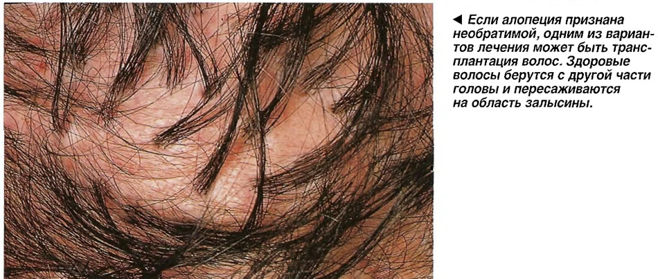 Если алопеция признана необратимой, одним из вариантов лечения может быть трансплантация волос