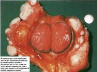 Если фиброма достигает больших размеров ее необходимо удалить