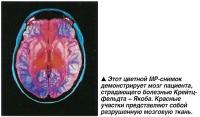 Этот цветной МР-снимок демонстрирует мозг пациента, страдающего болезнью Крейтцфельдта - Якоба
