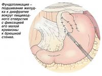 Фундопликация - подшивание желудка к диафрагме вокруг пищеводного отверстия