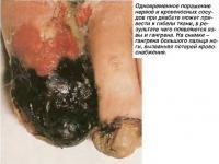 Гангрена большого пальца ноги, вызванная потерей кровоснабжения