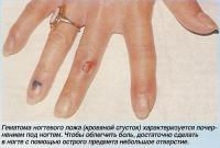 Гэматома ногтевого ложа