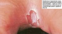 Гоибковые поражения кожи - дрожжевая инфекция кандида