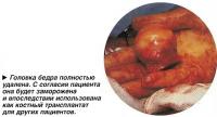 Головка бедра полностью удалена