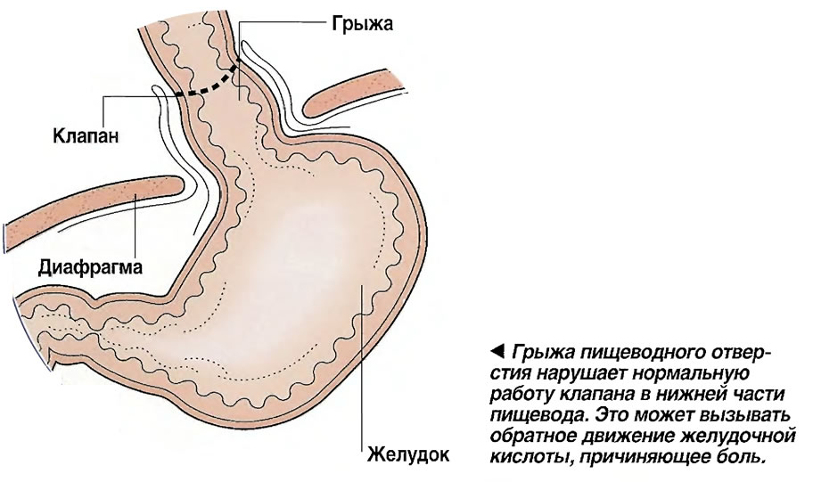 Чем опасна грыжа пищевода