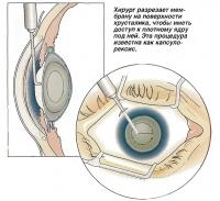 Хирург разрезает мембрану на поверхности хрусталика