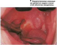 Хирургическими ножницами делается надрез слизистой оболочки миндалины