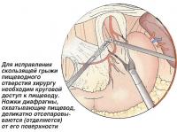 Хирургу необходим круговой доступ к пищеводу