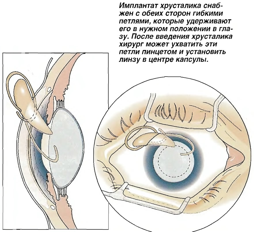 Пересадка Хрусталика Стоимость