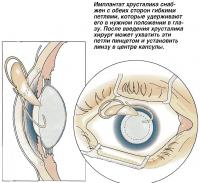 Имплантат хрусталика снабжен с обеих сторон гибкими петлями