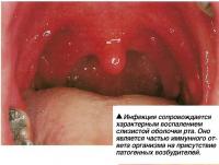 Инфекция сопровождается характерным воспалением слизистой оболочки рта