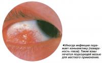 Иногда инфекция поражает конъюнктиву (поверхность глаза)