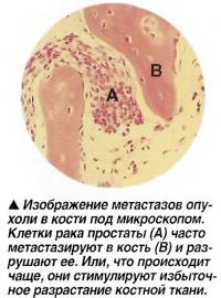 Изображение метастазов опухоли в кости под микроскопом