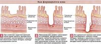 Как формируется язва