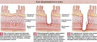 Как формируется язва