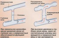 Как образуются варикозные вены