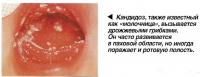 Кандидоз, также известный как «молочница», вызывается дрожжевыми грибками