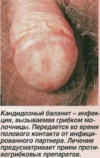 Кандидозный баланит - инфекция, вызываемая грибком молочницы
