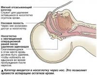 Катетер вводится в носоглотку через нос