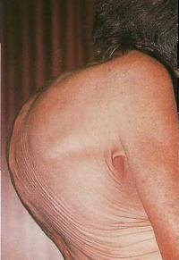 Кифоз - аномальная кривизна позвоночника, образующая характерный горб