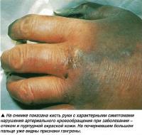 Кисть руки с характерными симптомами нарушения кровообращения