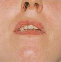 Классический симптом столбняка - сжатые мышцы челюсти - тризм челюсти