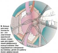 Кольцо для аннулопластики