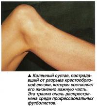 Коленный сустав, пострадавший от разрыва крестообразной связки