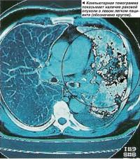 Компьютерная томограмма показывает наличие раковой опухоли в левом легком