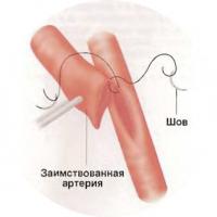 Конец левой внутренней грудной артерии