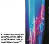 Контрастная рентгенограмма показывает тромбоз глубоких вен