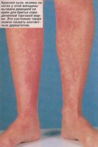 Красная сыпь экземы на ногах у женщины вызвана реакцией на крем для бритья