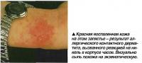 Красная воспаленная кожа на этом запястье - результат аллергического контактного дерматита