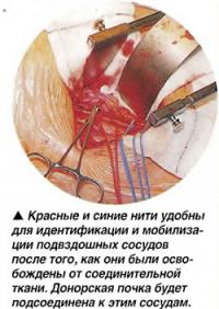 Красные и синие нити удобны для идентификации и мобилизации подвздошных сосудов