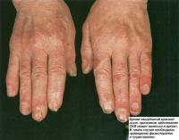 Кроме чешуйчатой красной сыпи, признаком заболевания СКВ может являться и артрит
