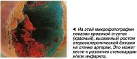 Кровяной сгусток (красный), вызванный ростом атеросклеротической бляшки на стенке артерии