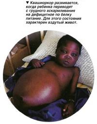 Квашиоркор развивается, когда ребенка переводят с грудного вскармливания на дефицитное по белку пита