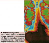 Легкие пациента с пневмонией