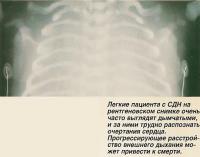 Легкие пациента с СДН на рентгеновском снимке