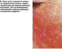 Лицо этого пациента покрыто чешуйчатой сыпью, характерной для системной красной волчанки